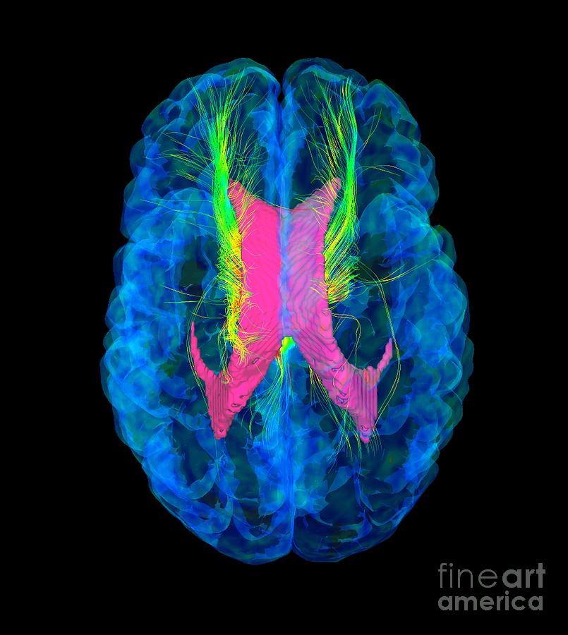 Brain Fibres, Dti Mri Scan Photograph by Sherbrooke Connectivity ...