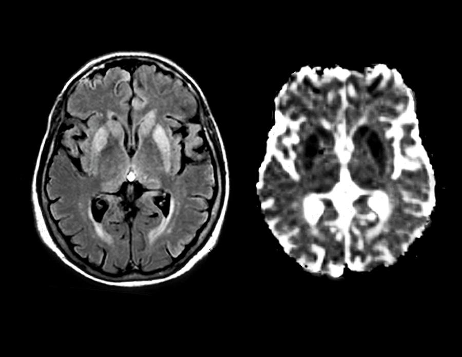 Brain In Creutzfeldt-jakob Disease #3 Photograph by Zephyr