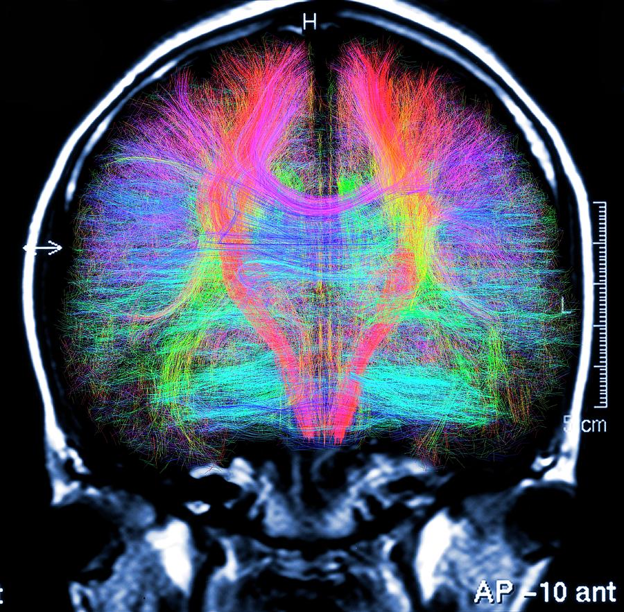 Brain Mri And White Matter Fibres Photograph by Alfred Pasieka/science Photo Library
