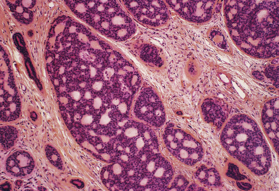 Breast Cancer #3 Photograph by Cnri/science Photo Library