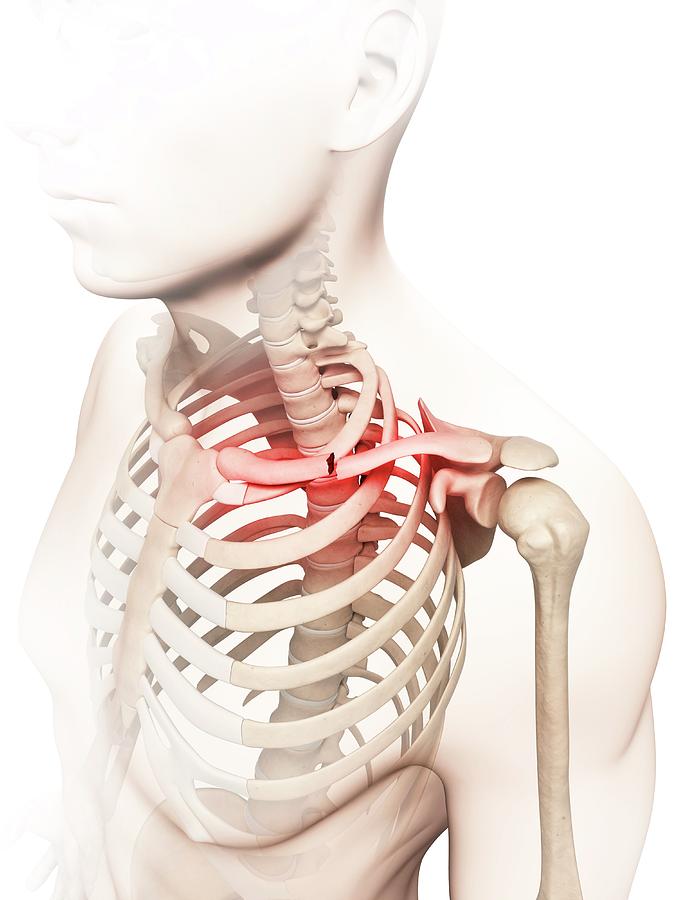 metal collar bones