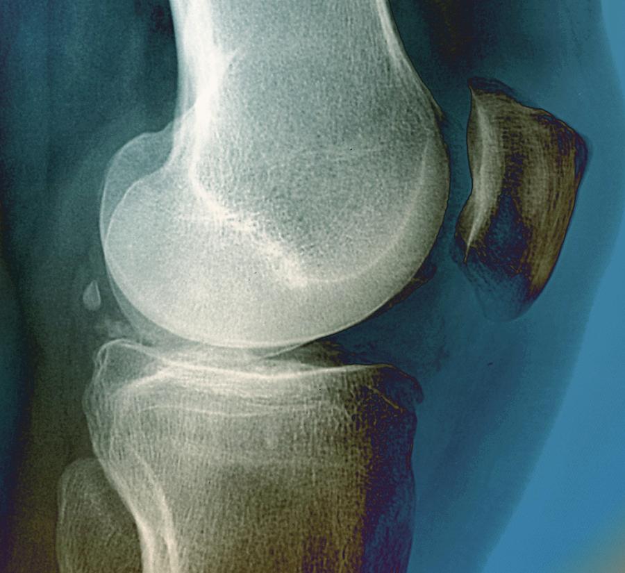 Calcification In The Knee #3 Photograph by Zephyr
