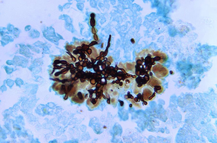 Candida Albicans, Fungal Infection, Lm #3 Photograph by Science Source
