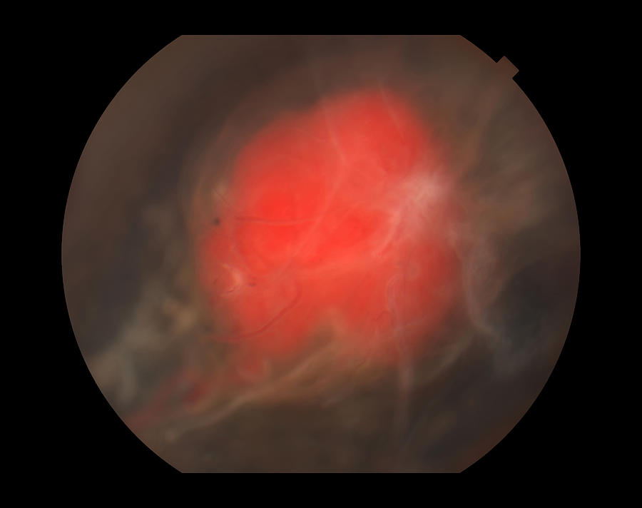 Capillary Hemangioma, Ophthalmic #3 Photograph by Paul Whitten