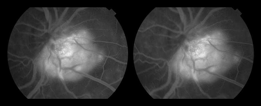 Capillary Hemangioma, Stereo Image #3 Photograph by Paul Whitten