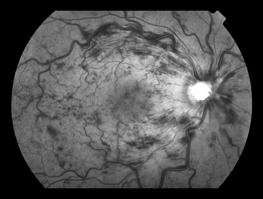 Central Retinal Vein Occlusion #3 Photograph by Paul Whitten