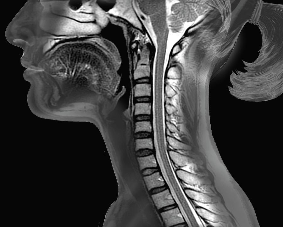 Cervical Spine And Brainstem #3 Photograph by Zephyr/science Photo Library