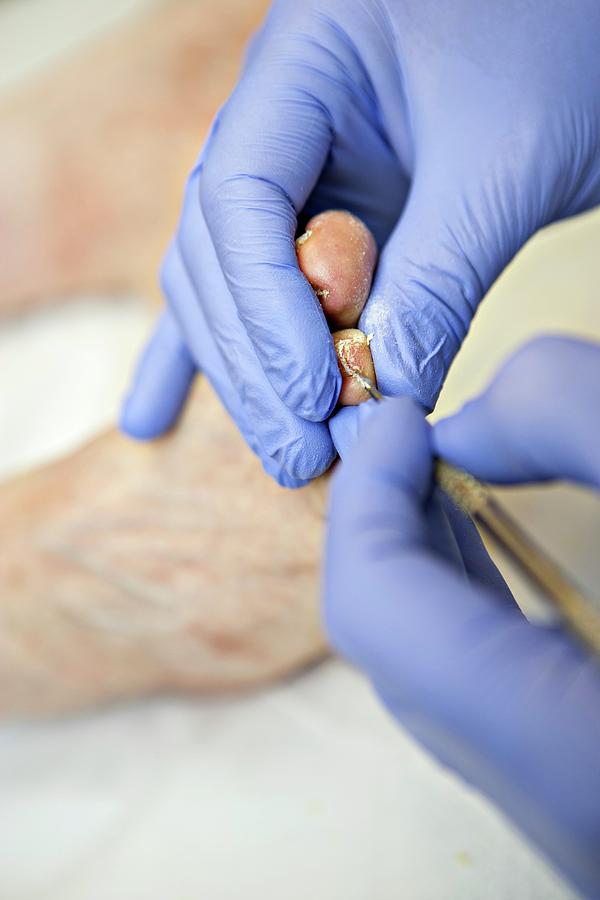 Chiropody Treatment Photograph by Lewis Houghton/science Photo Library ...