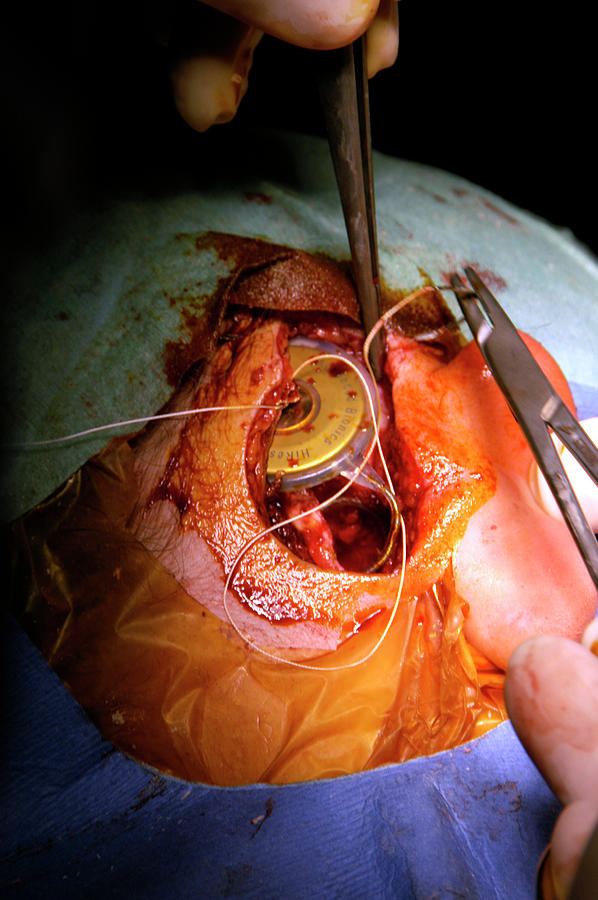Paris Photograph - Cochlear Implant Surgery #3 by Aj Photo/science Photo Library