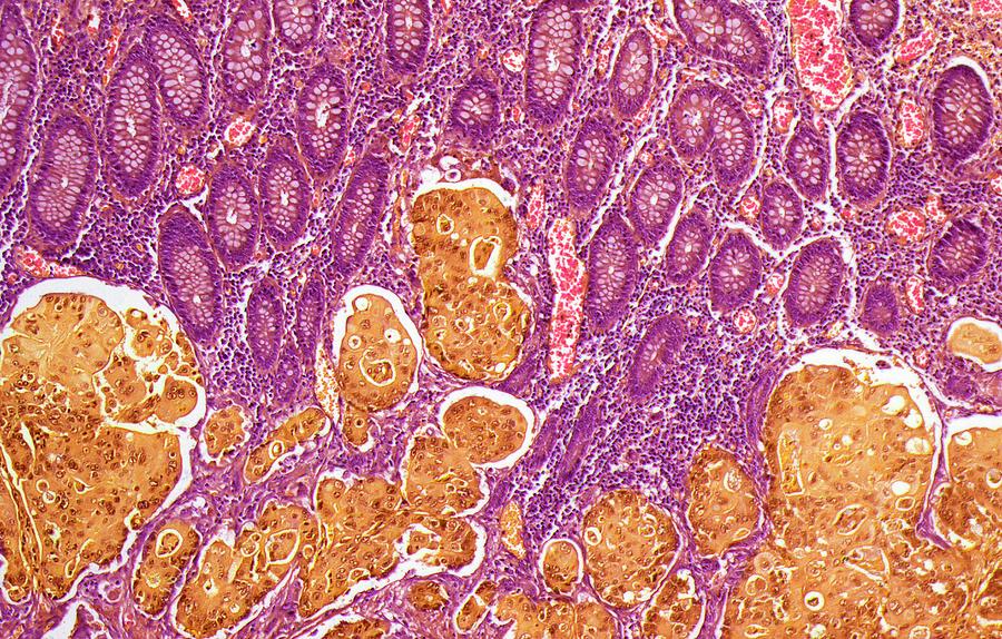 Colon Cancer #3 by Steve Gschmeissner/science Photo Library