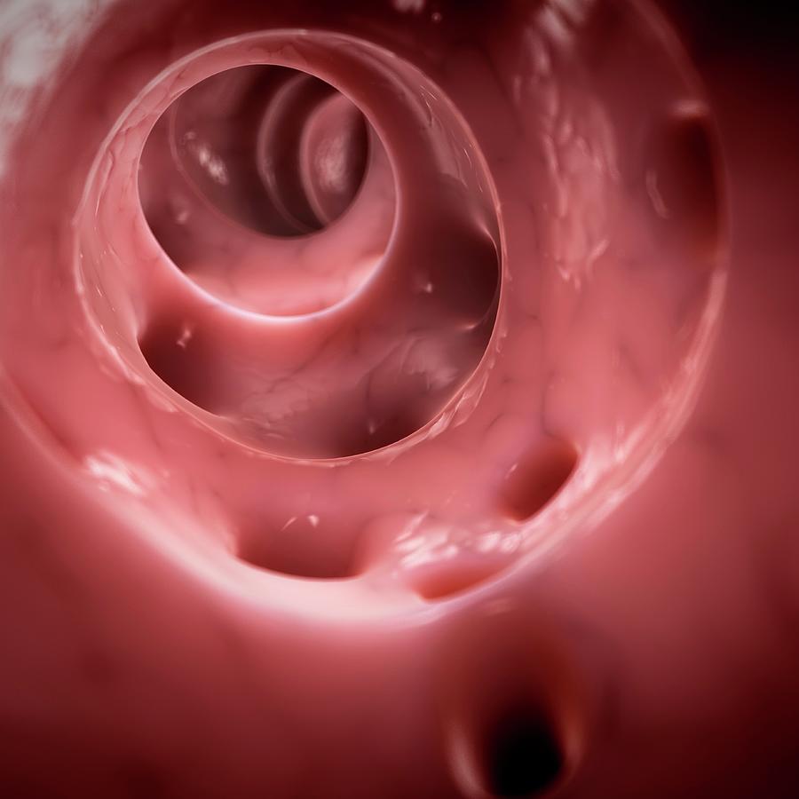 Colon Diverticuli Photograph By Scieproscience Photo Library Fine Art America 3627