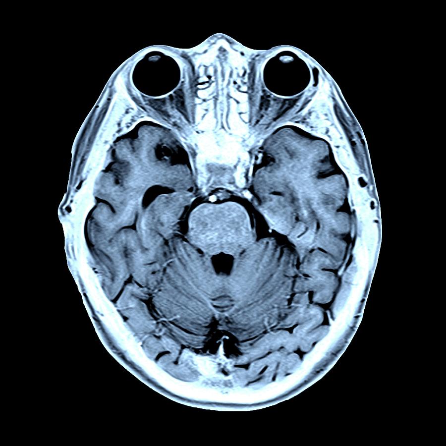 Coloured Mri Scan Of The Human Head #3 by Alfred Pasieka/science Photo ...