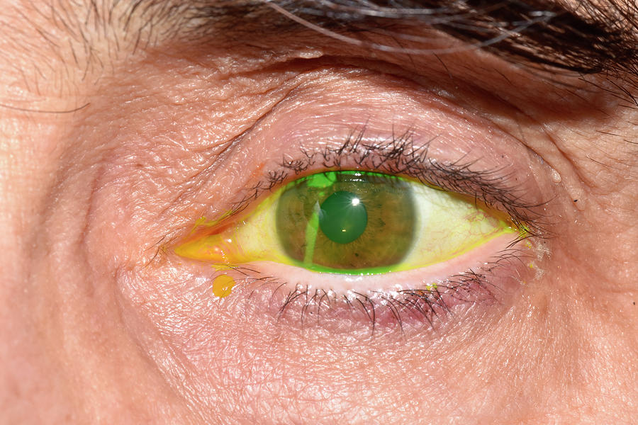 Corneal Abrasion Photograph by Dr P. Marazzi/science Photo Library