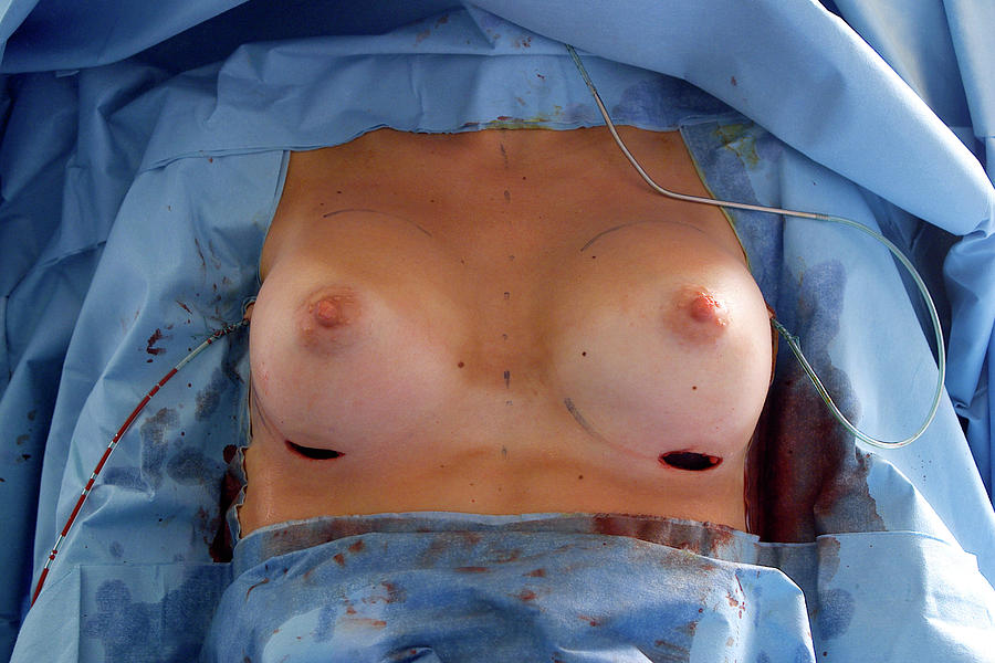 Cosmetic Breast Surgery #3 Photograph by Aj Photo/science Photo Library