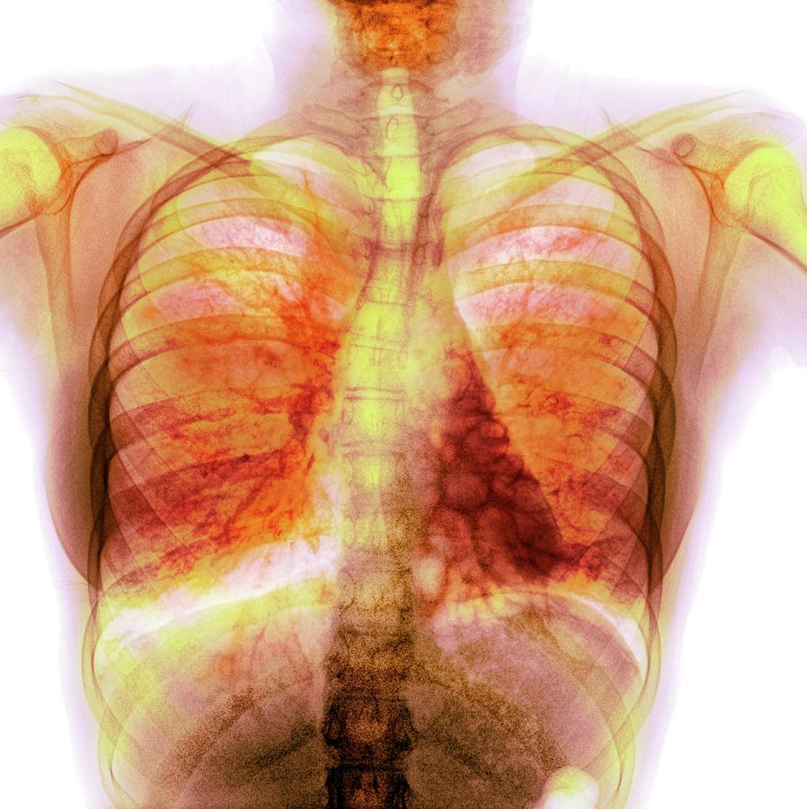 Cystic Fibrosis #3 Photograph by Photostock-israel/science Photo Library