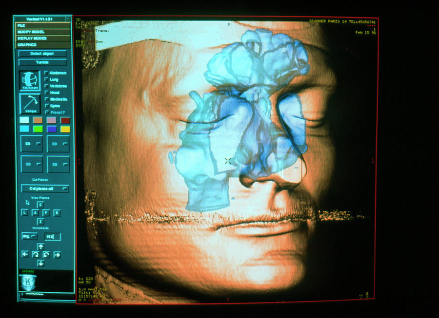 3-d Ct Scan Of The Head Showing The Sinuses Photograph by Pascal Goetgheluck/science Photo Library