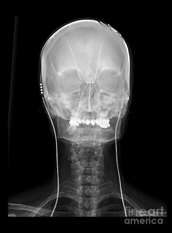 Deep Brain Stimulating Electrodes, X-ray #3 Photograph by Living Art Enterprises