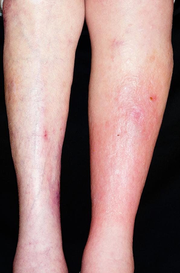 Deep Vein Thrombosis In The Leg Photograph by Dr P. Marazzi/science ...