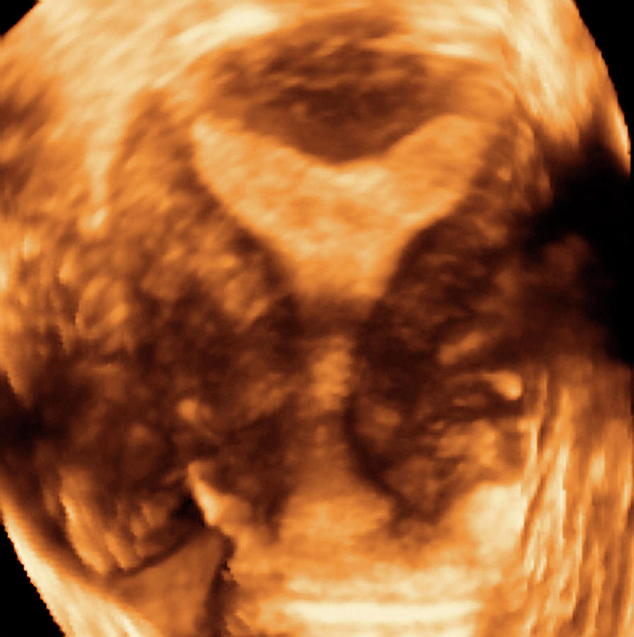 misshapen uterus misshapen uterus