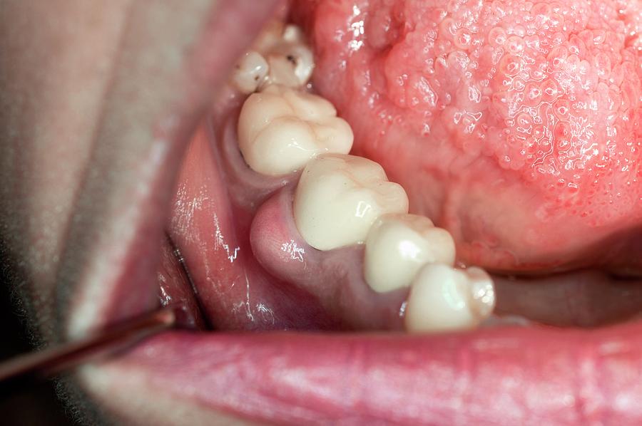 Does Tooth Abscess Affect The Brain