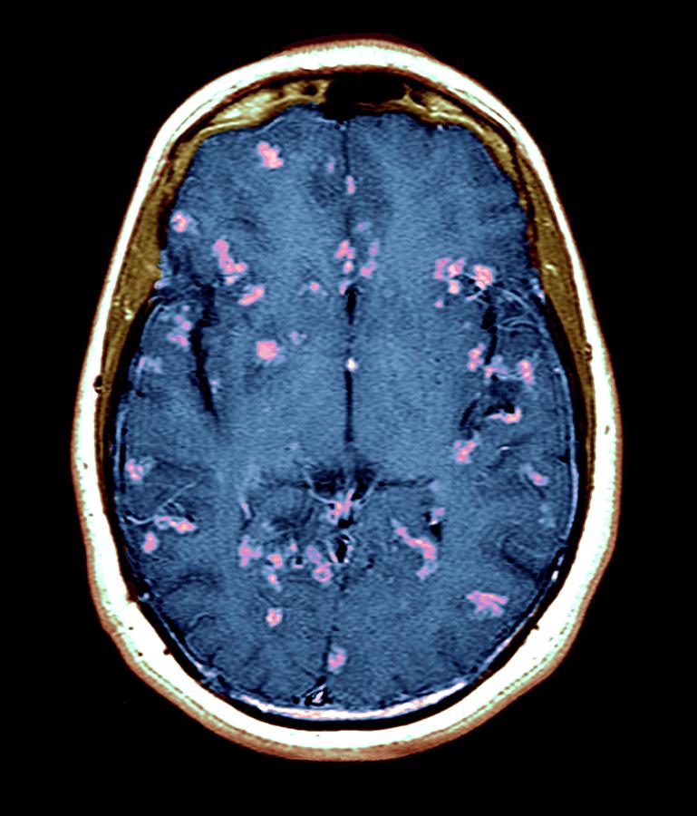 Diseased Brain Photograph by Zephyr/science Photo Library | Fine Art ...