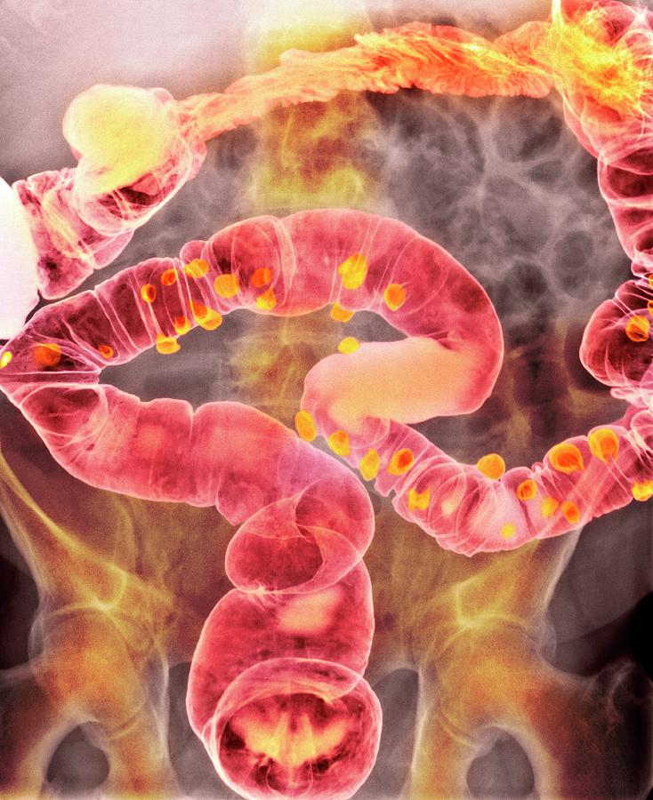 Diverticulitis #3 Photograph by Science Photo Library