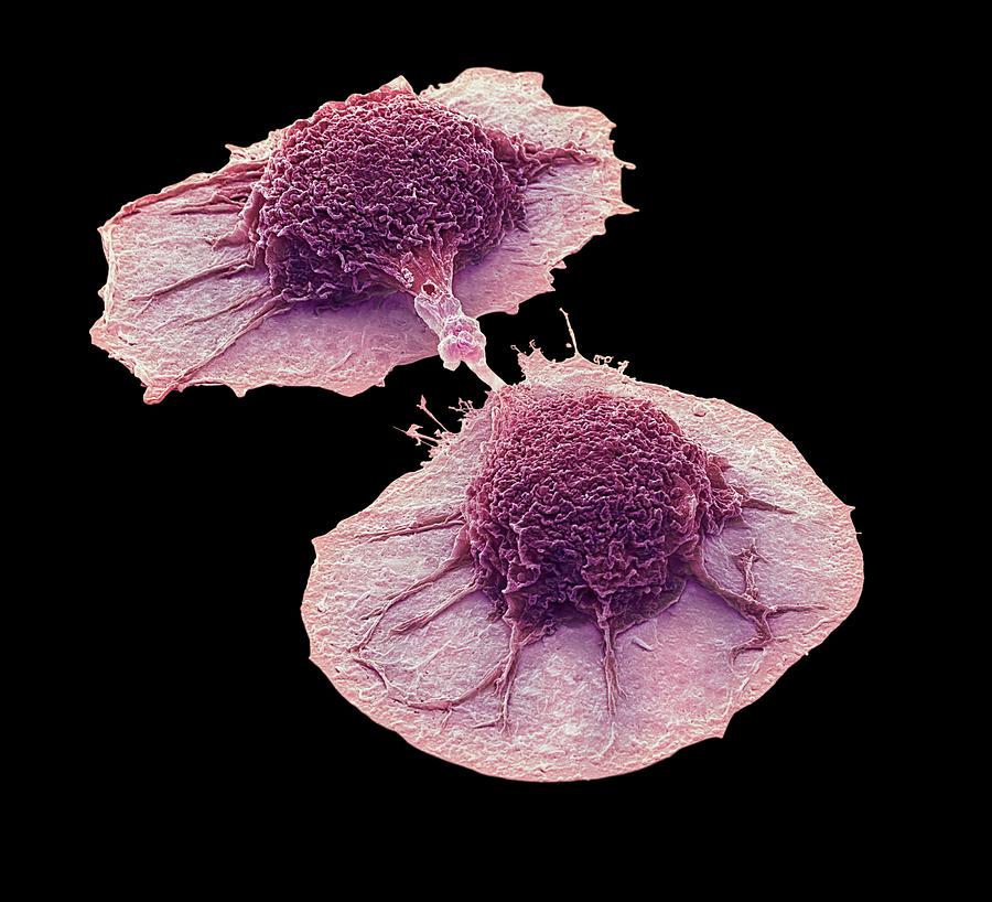 Abnormal Photograph - Dividing Lung Cancer Cells #3 by Steve Gschmeissner