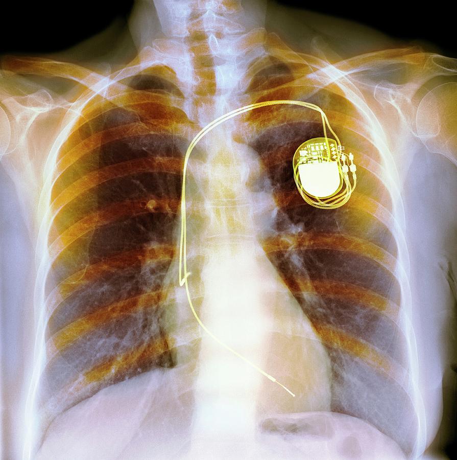 Dual Chamber Pacemaker Photograph By Science Photo Library | My XXX Hot ...