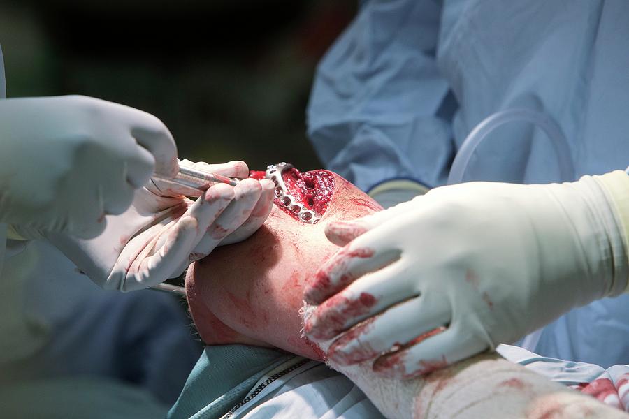 Elbow Surgery #3 Photograph by Mark Thomas/science Photo Library