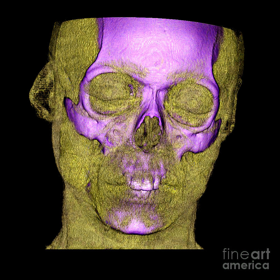 Enhanced 3d Ct Of Face And Skull #3 Photograph by Living Art Enterprises