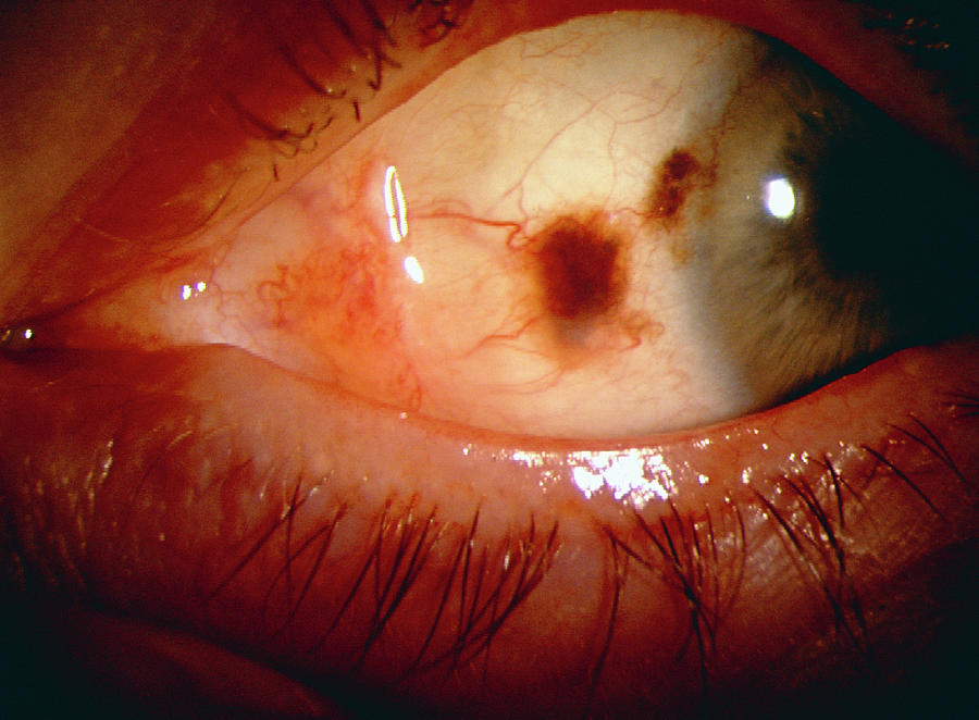 Eye Cancer Photograph By Sue Fordscience Photo Library Pixels 