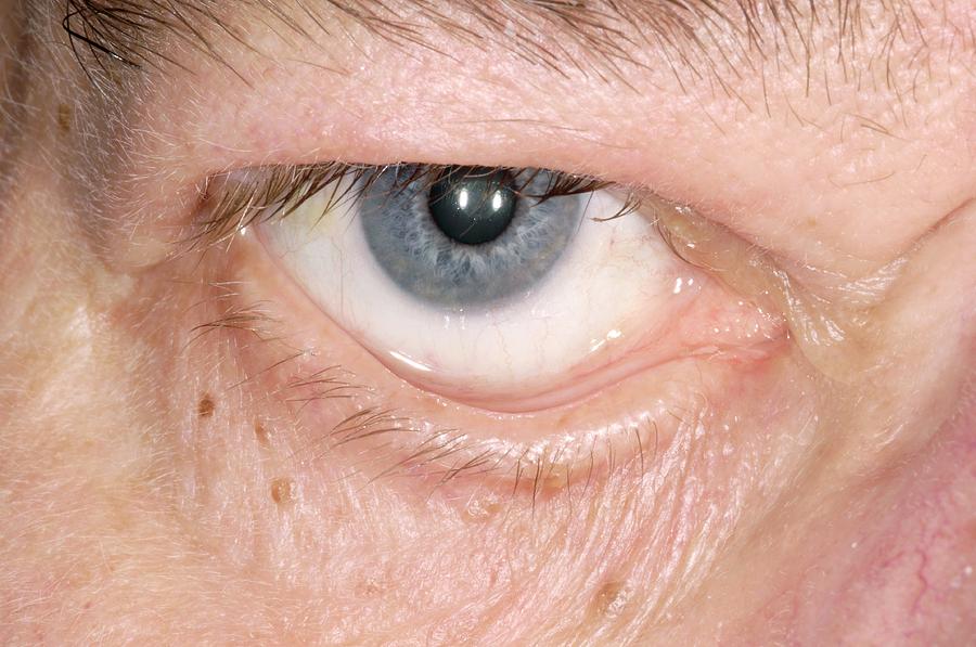 Eyelid Surgery Photograph By Dr P Marazziscience Photo Library