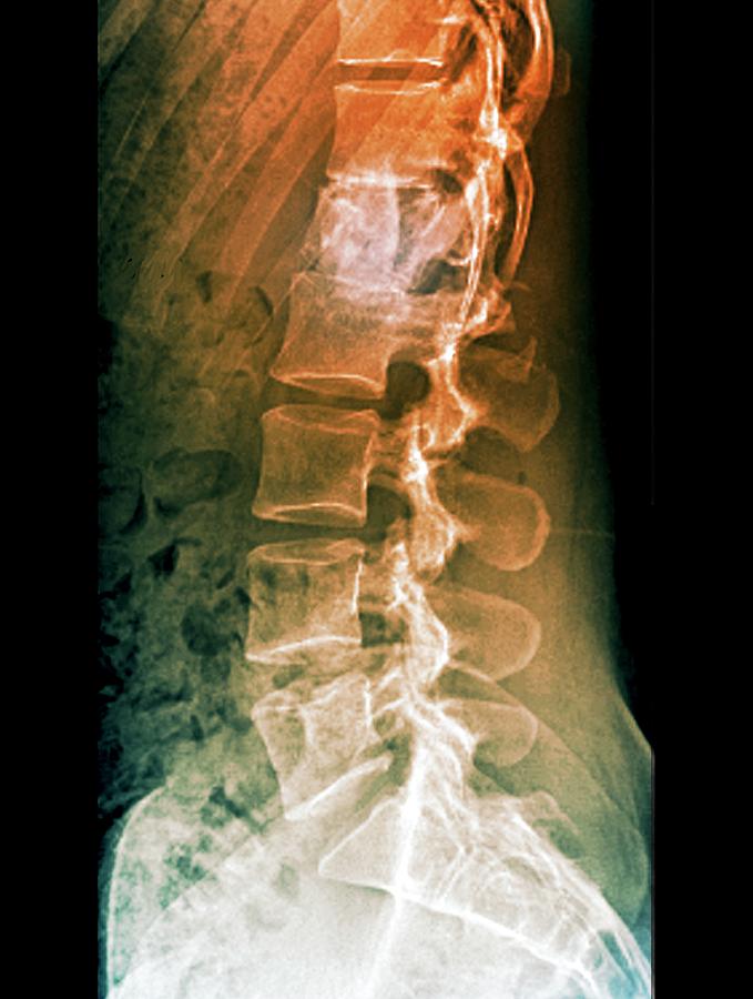 Fixed Spinal Fracture Photograph by Zephyr Pixels