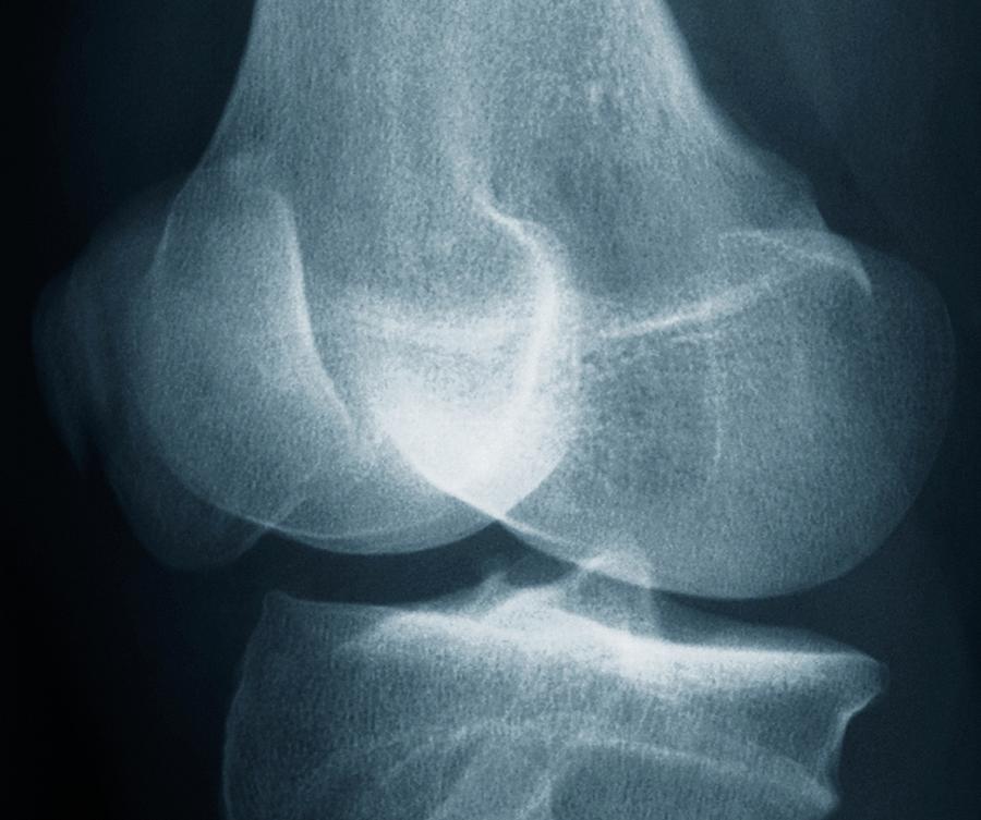 hairline fracture in knee