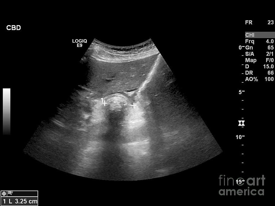 Gallstone, Ultrasound Scan Photograph by Science Photo Library - Fine ...