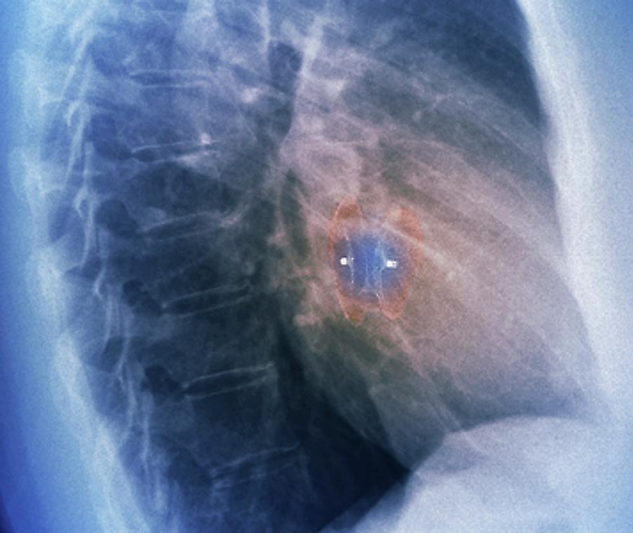 Heart Defect Implant #3 Photograph by Zephyr/science Photo Library