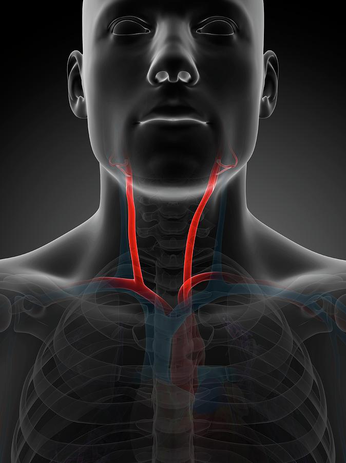 Аневризма сонной артерии шеи фото