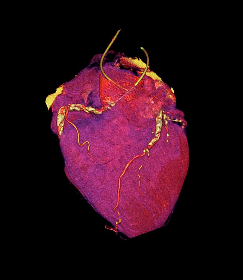 Organ Photograph - Human Heart #3 by Anders Persson, Cmiv