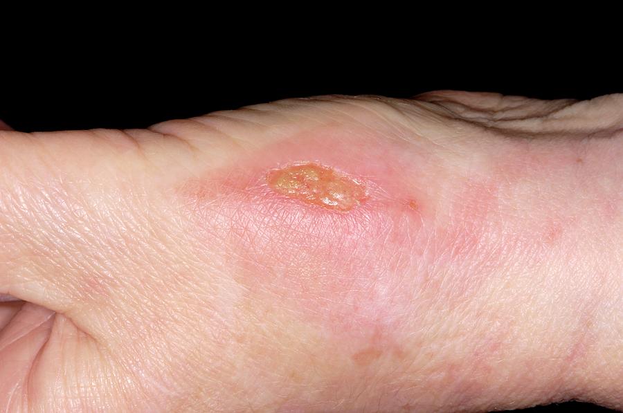 how-to-tell-if-a-wound-is-healing-or-infected-osf-healthcare