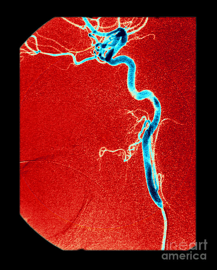 Arterial Angiogram Photograph - Internal Carotid Artery, Angiogram #3 by Living Art Enterprises