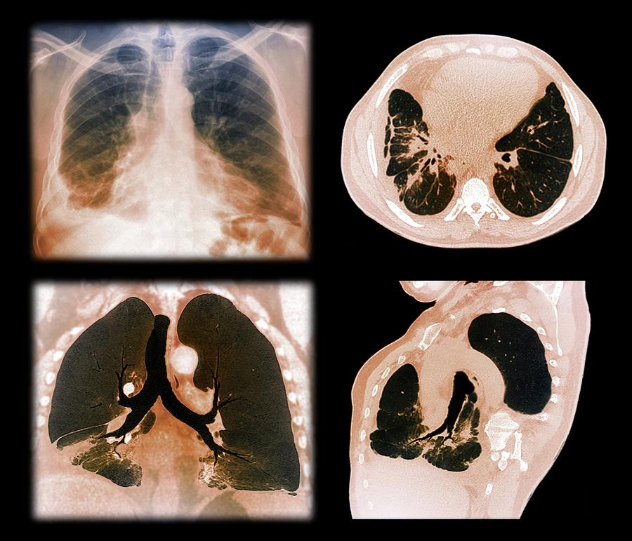 Kaposi's Sarcoma Of The Lung Photograph by Zephyr/science Photo Library ...