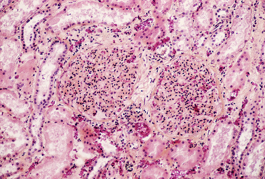 Kidney Inflammation Photograph by Cnri/science Photo Library - Pixels