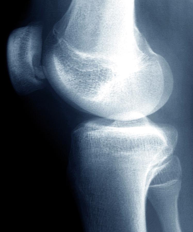 Xray Photograph - Knee Disease #3 by Zephyr/science Photo Library