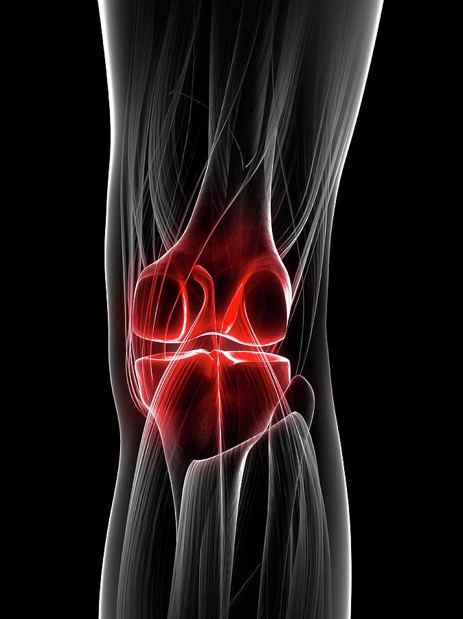 Knee Pain #3 Photograph by Sciepro/science Photo Library - Pixels