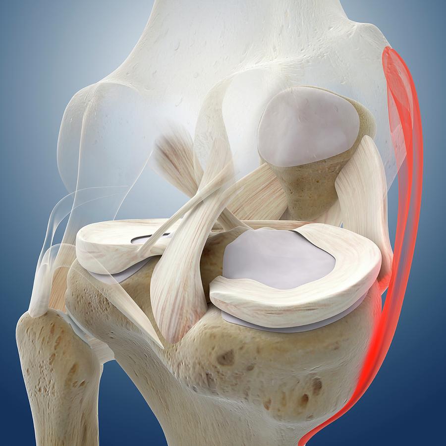 Knee Pain #3 Photograph by Springer Medizin/science Photo Library