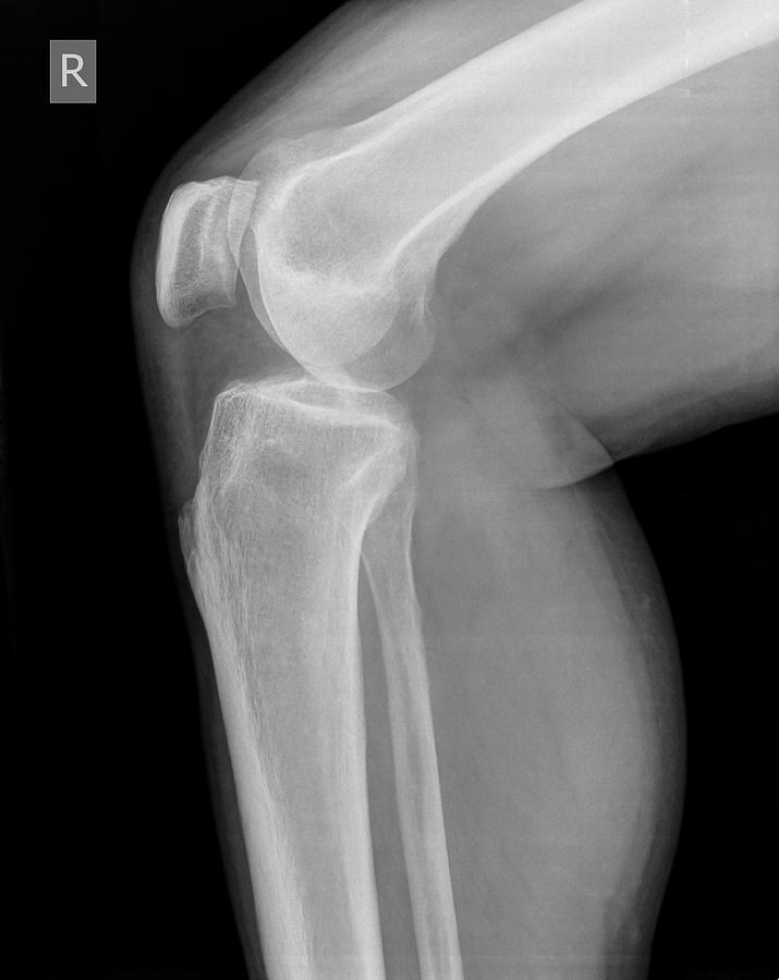 Skeleton Photograph - Knee X-ray #3 by Photostock-israel