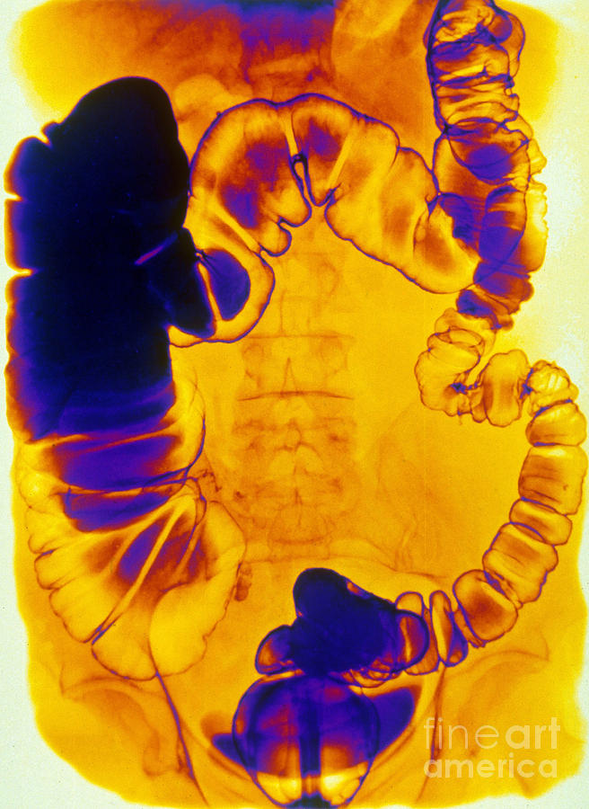 Medical Photograph - Large And Small Intestine, Barium X-ray #3 by Scott Camazine