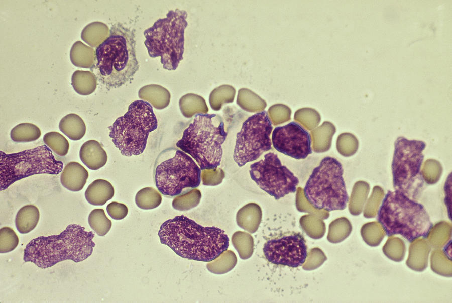 Leukemia #3 Photograph by Biology Pics