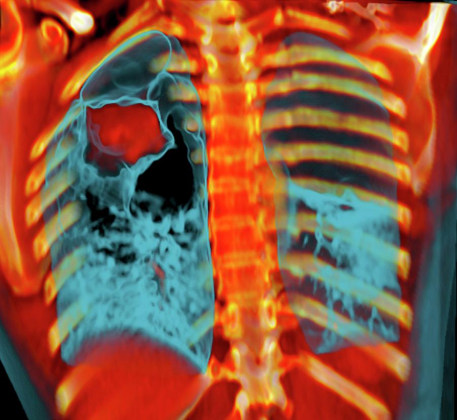 Lung Cancer #3 Photograph By Du Cane Medical Imaging Ltd - Pixels