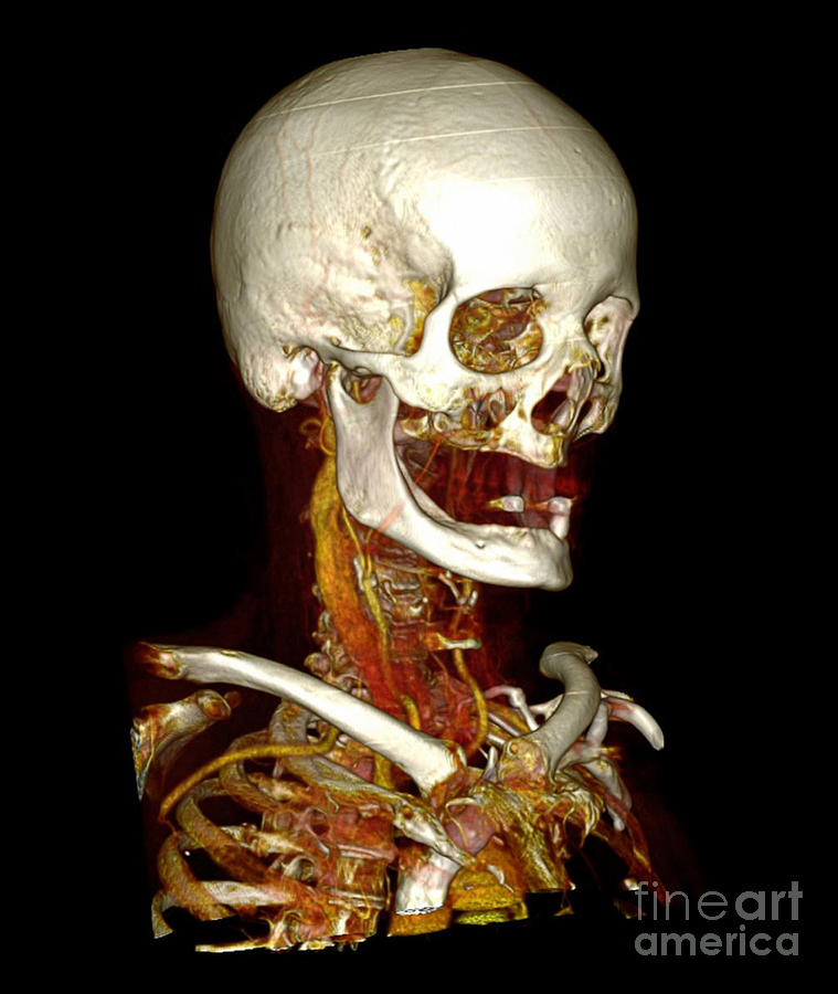 Male Skull & Arterial System #3 Photograph by Scott Camazine